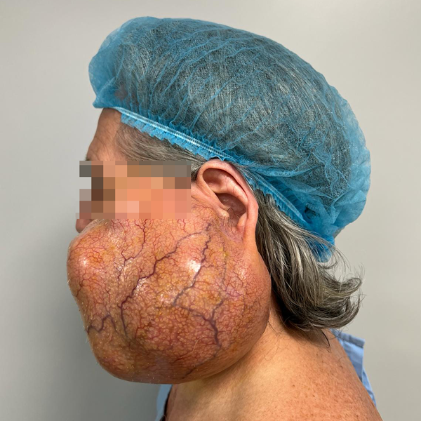 O tumoră facială cu diametru de peste 30 de centimetri și peste 800 de grame, operata în siguranță la Spitalul Arcadia