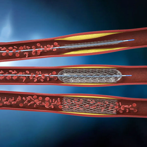 Angioplastia coronariană cu stent: explicații pe înțelesul tuturor