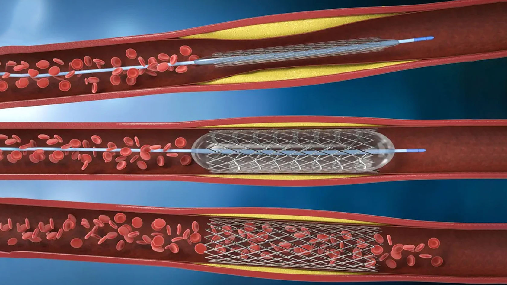 Angioplastia coronariană cu stent: explicații pe înțelesul tuturor