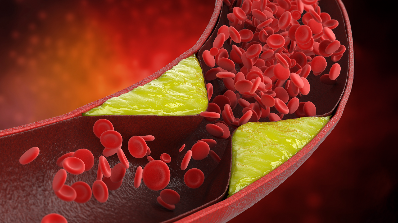 Ateroscleroza cerebrală