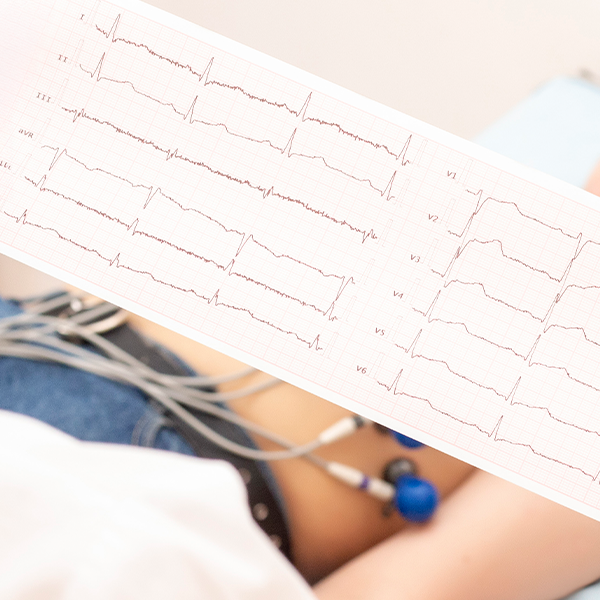 Electrocardiograma, un test simplu, dar esențial pentru evaluarea sănătății inimii