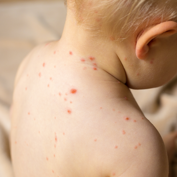 Varicela la copii: ce trebuie să știi despre această boală contagioasă
