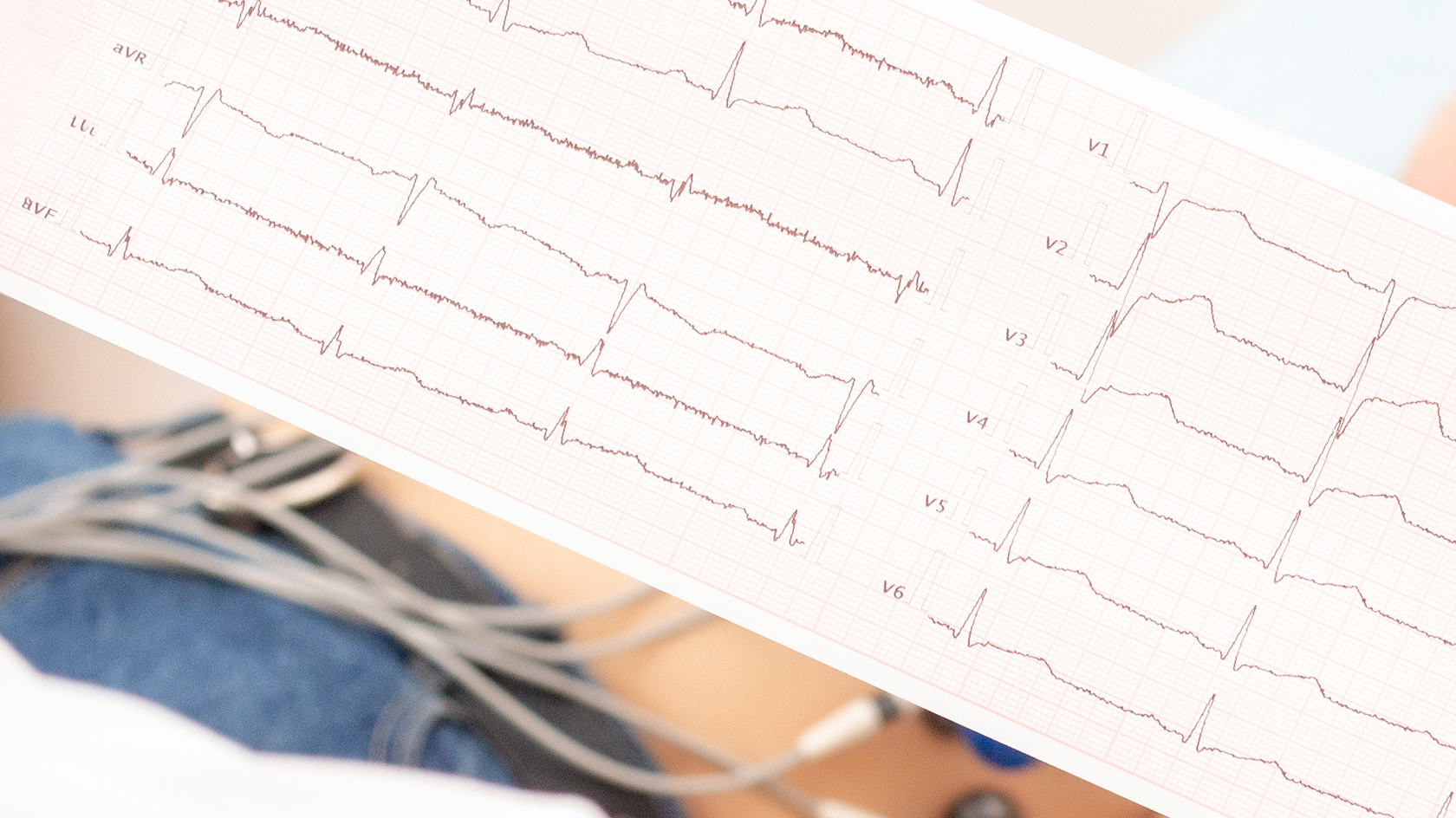 Electrocardiograma, un test simplu, dar esențial pentru evaluarea sănătății inimii