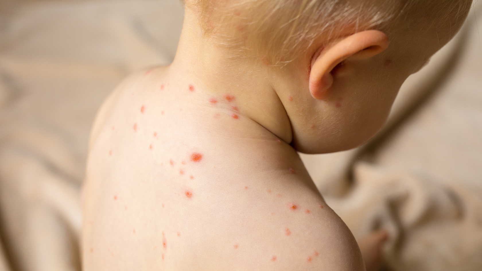 Varicela la copii: ce trebuie să știi despre această boală contagioasă