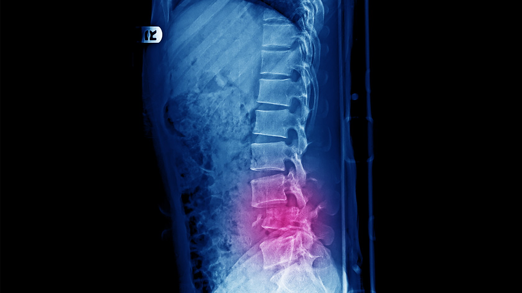 Fracturile de coloană: de ce recuperarea nu se oprește la externare?